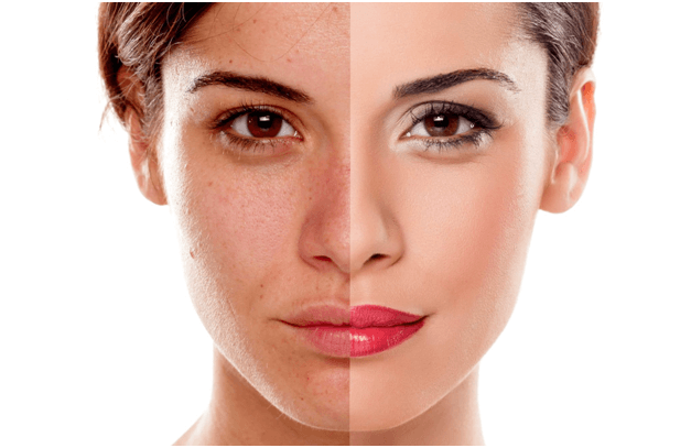 Chemical Peels And Your Skin