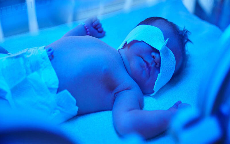 Bebeklerde Sarılık Neden Olur? Sarılık İçin Evde Işık Tedavisi