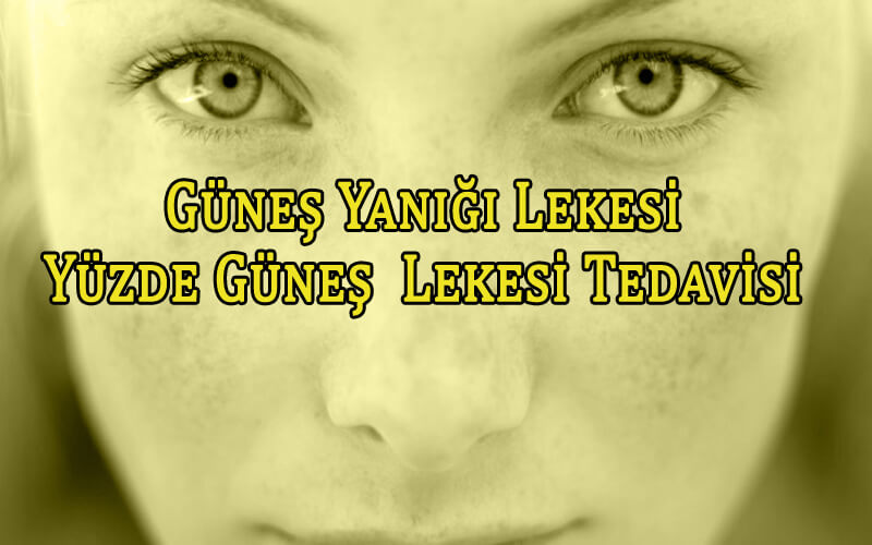 Güneş Yanığı Lekesi - Yüzde Güneş Lekesi Tedavisi