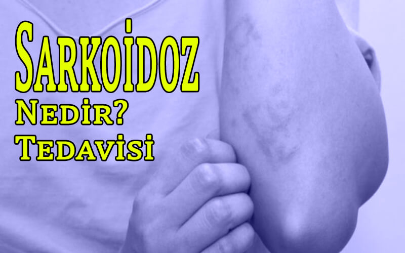 Sarkoidoz Nedir? Sarkoidoz Tedavisi - Belirtileri