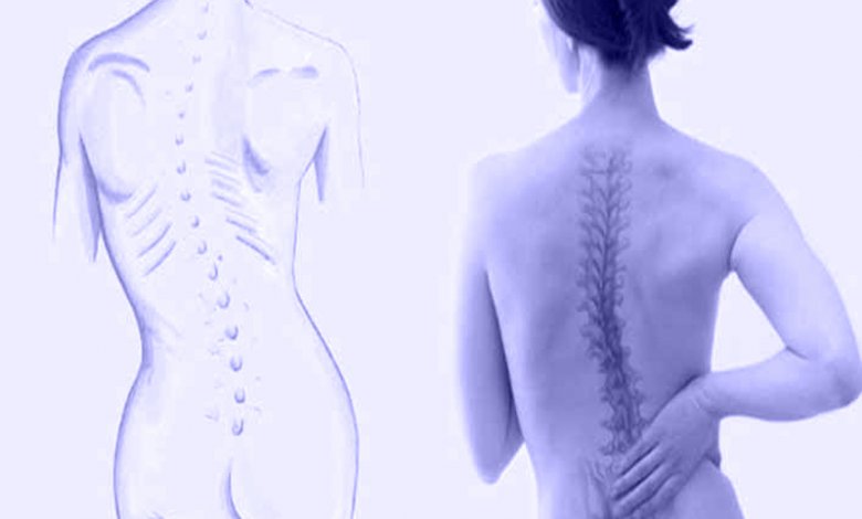 Skolyoz Nedir?