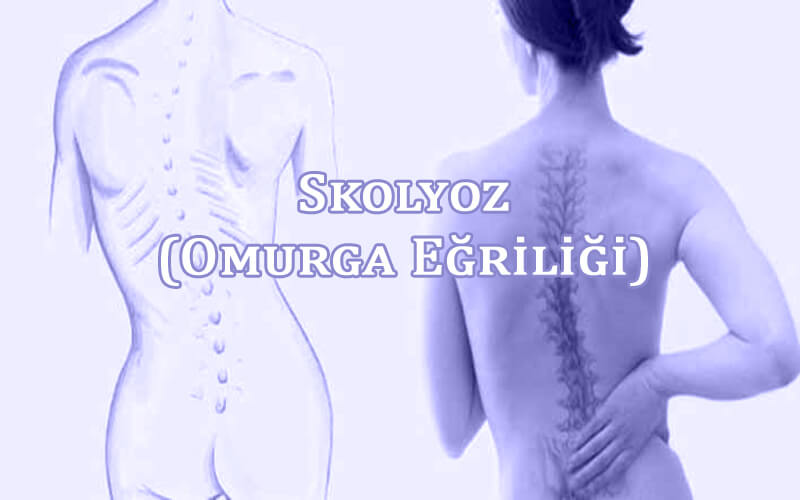 Skolyoz Nedir?